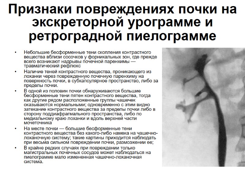 Признаки повреждениях почки на экскреторной урограмме и ретроградной пиелограмме  Небольшие бесформенные тени скопления